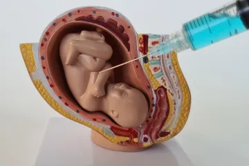 assistolia fetal